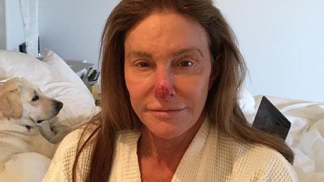 Caitlyn Jenner shows off the result of her sun damage.Source:Instagram