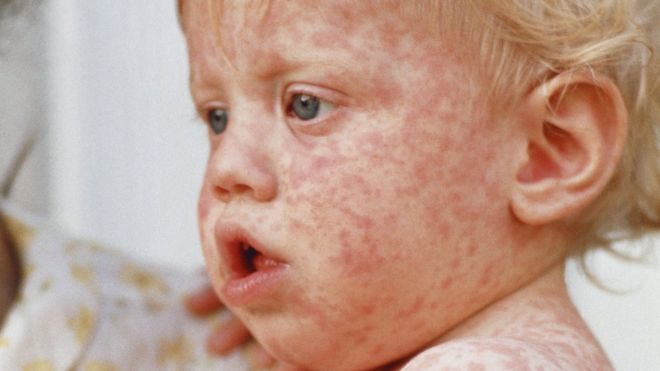 SCIENCE PHOTO LIBRARY / Stock picture of a child with measles